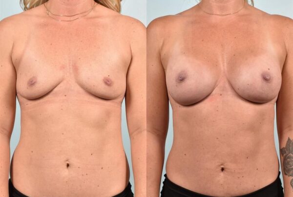 Power Assisted Liposuction 15