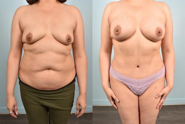 Power Assisted Liposuction 16