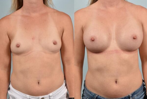 Power Assisted Liposuction 17