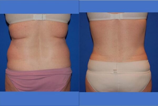 Power Assisted Liposuction 18
