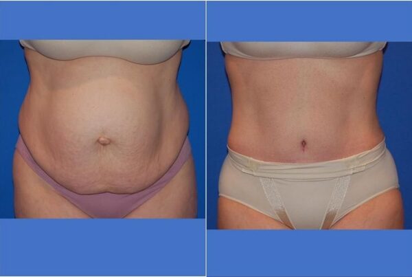 Power Assisted Liposuction 19