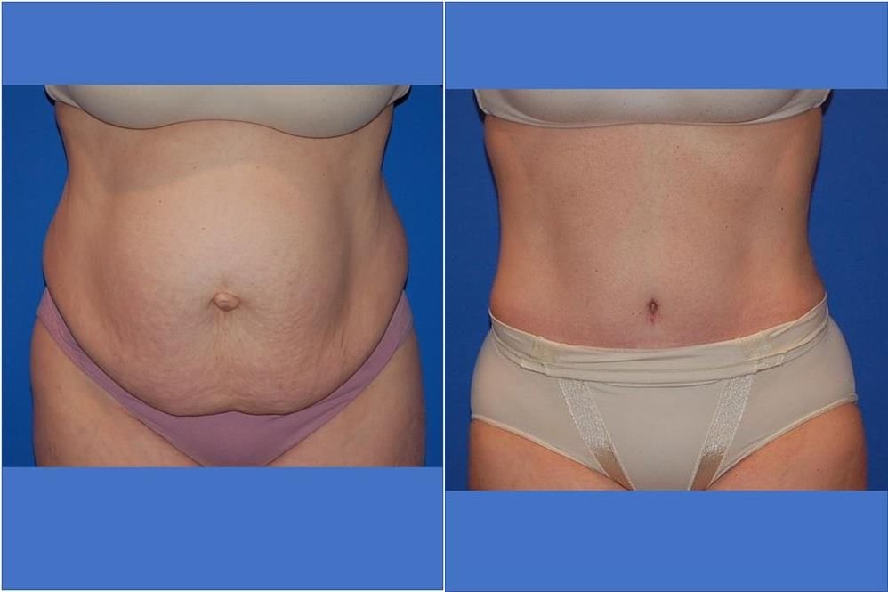 Power Assisted Liposuction 19