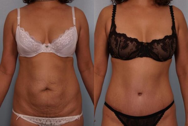 Power Assisted Liposuction 2