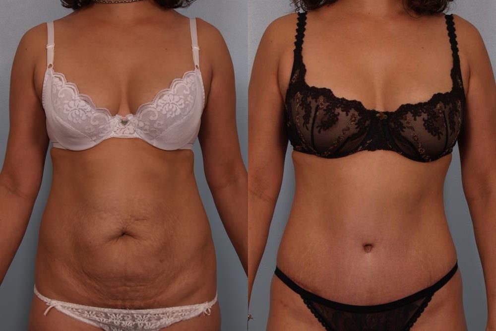 Power Assisted Liposuction 2