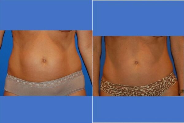 Power Assisted Liposuction 20