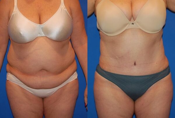 Power Assisted Liposuction 21