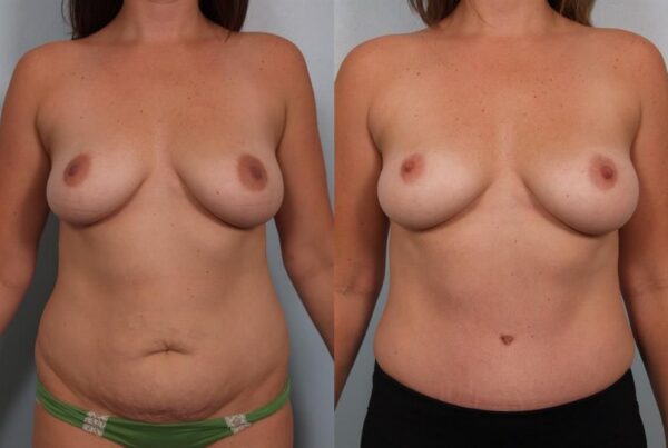 Power Assisted Liposuction 22