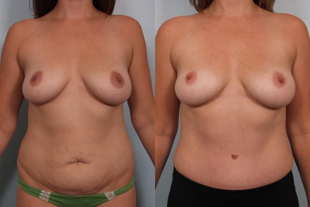 Power Assisted Liposuction 22