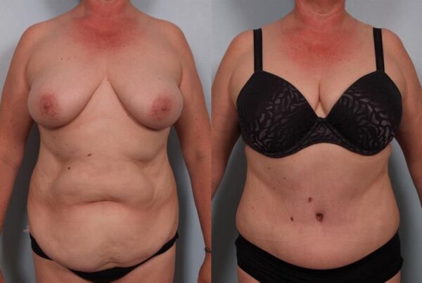 Power Assisted Liposuction 23
