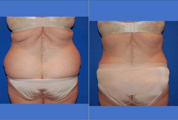 Power Assisted Liposuction 24