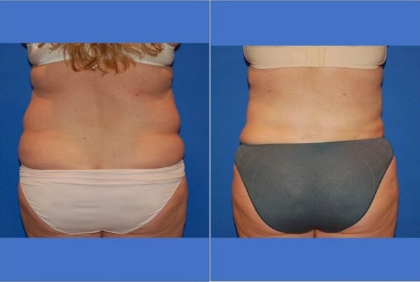 Power Assisted Liposuction 25