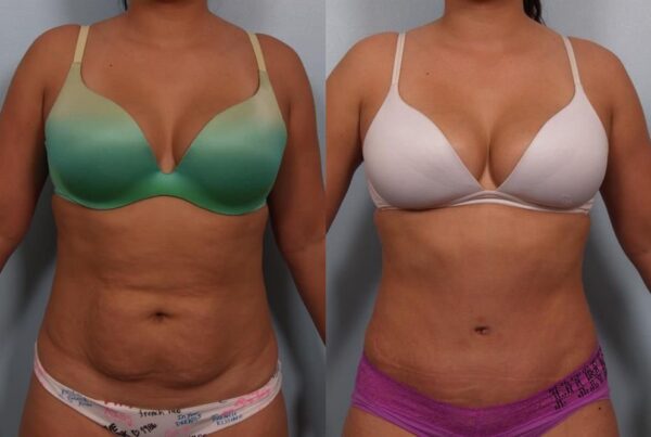 Power Assisted Liposuction 26
