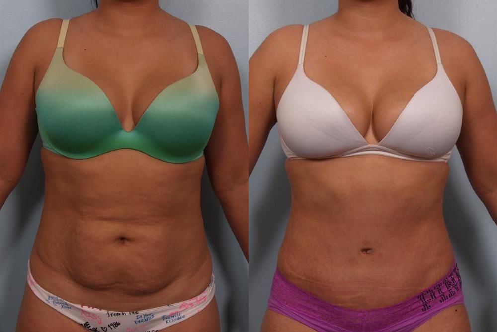 Power Assisted Liposuction 26