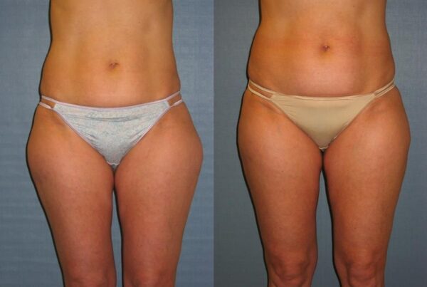 Power Assisted Liposuction 27