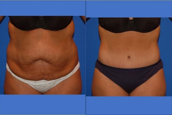 Power Assisted Liposuction 28