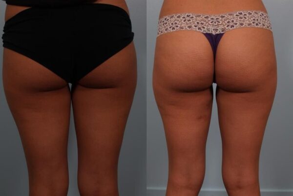 Power Assisted Liposuction 29