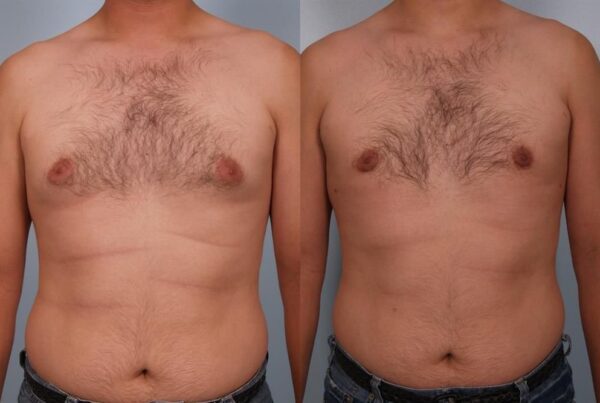 Power Assisted Liposuction 3