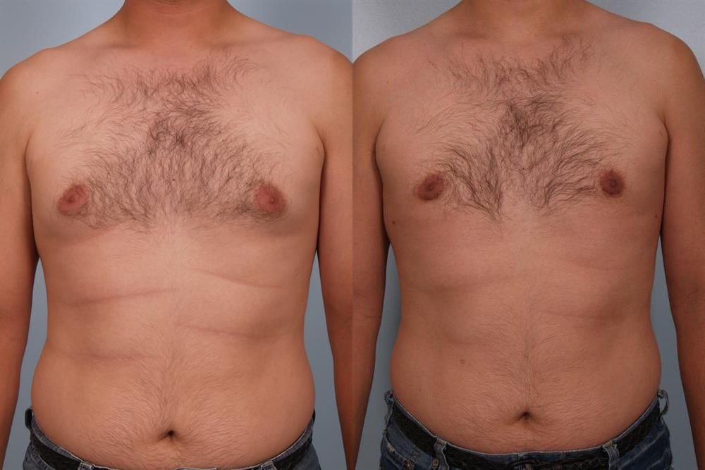 Power Assisted Liposuction 3