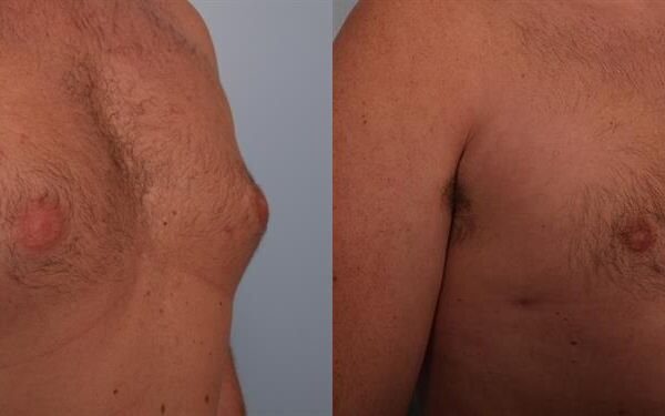 Power Assisted Liposuction 30