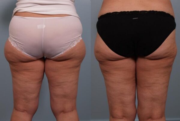 Power Assisted Liposuction 31