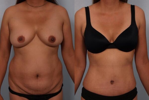 Power Assisted Liposuction 32
