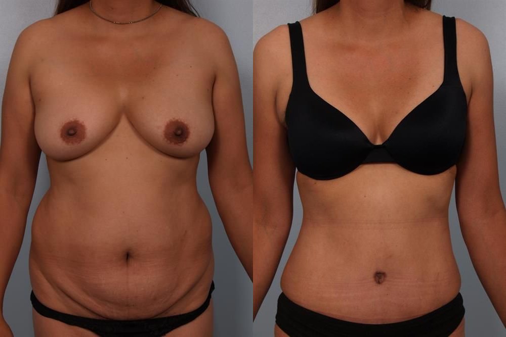 Power Assisted Liposuction 32