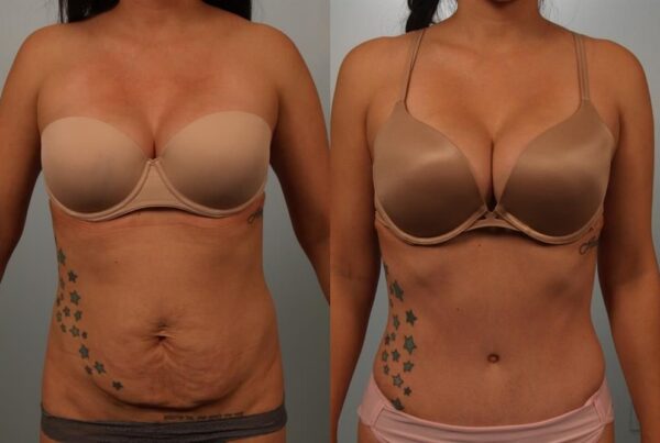 Power Assisted Liposuction 33