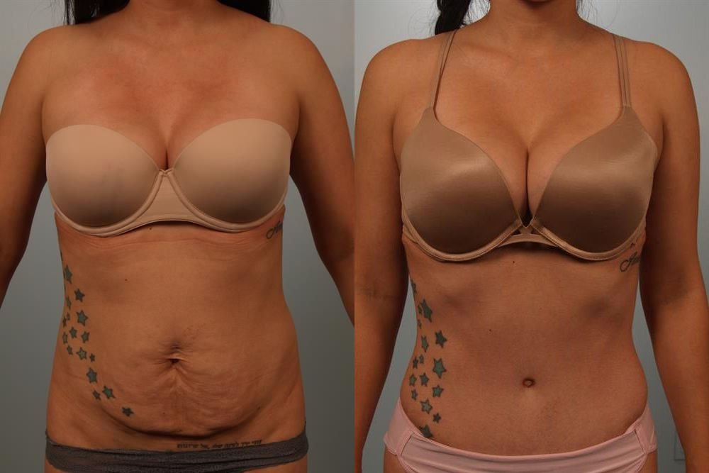 Power Assisted Liposuction 33