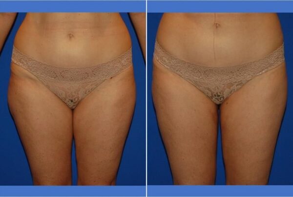Power Assisted Liposuction 34