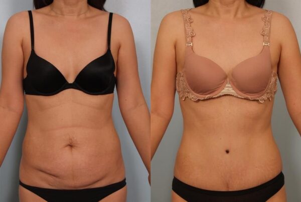Power Assisted Liposuction 35