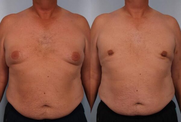 Power Assisted Liposuction 36