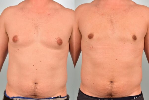 Power Assisted Liposuction 37