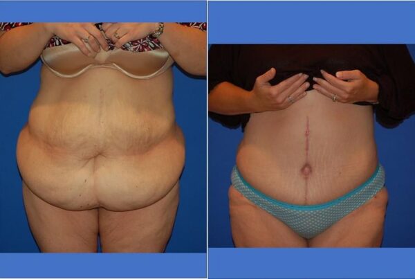 Power Assisted Liposuction 38