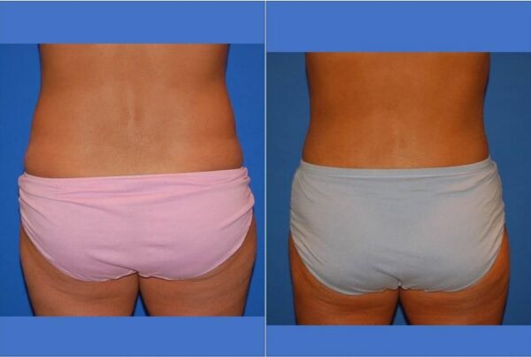 Power Assisted Liposuction 39