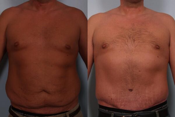 Power Assisted Liposuction 4