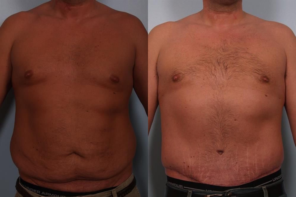 Power Assisted Liposuction 4