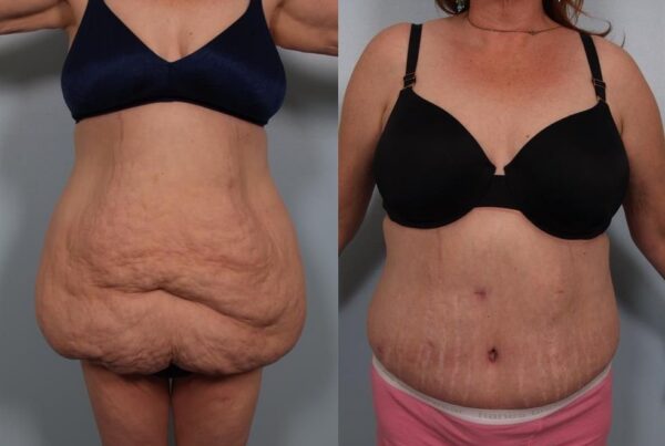 Power Assisted Liposuction 40