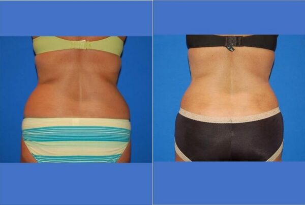 Power Assisted Liposuction 41
