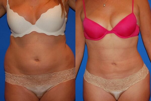 Power Assisted Liposuction 42