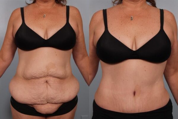 Power Assisted Liposuction 5