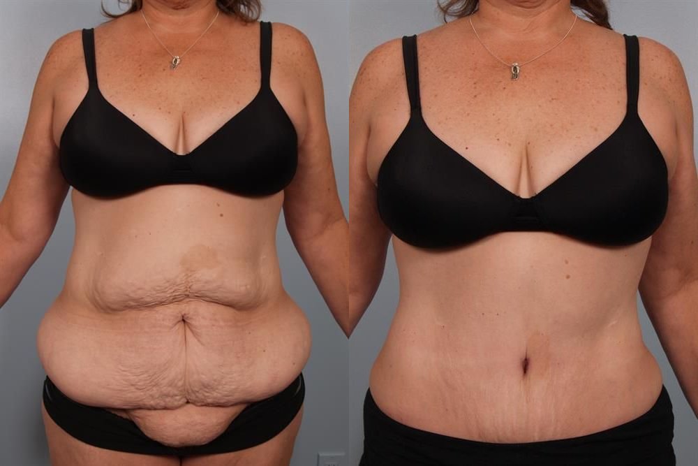 Power Assisted Liposuction 5