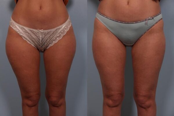 Power Assisted Liposuction 6