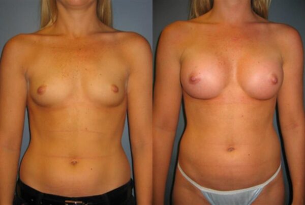 Power Assisted Liposuction 7