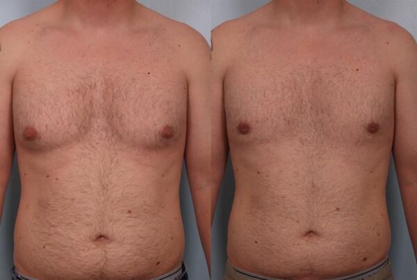 Power Assisted Liposuction 8
