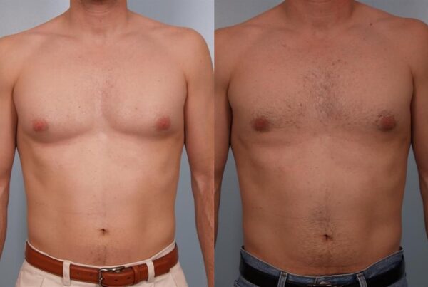Power Assisted Liposuction 9