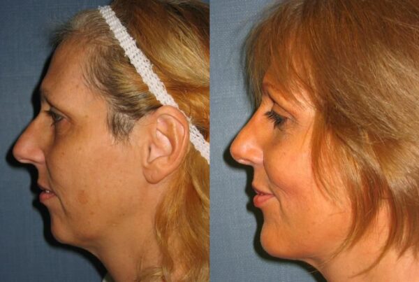 Restylane 1