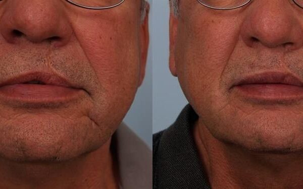 Restylane 2