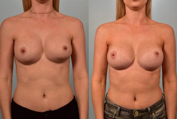 Revision Breast Surgery 1