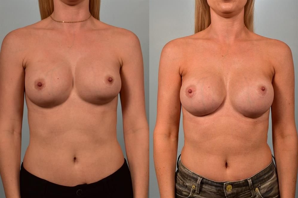 Revision Breast Surgery 1