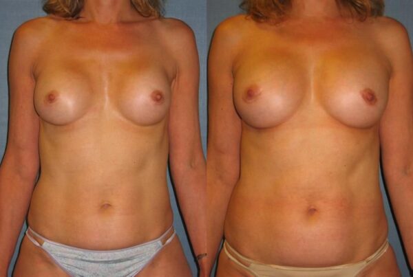 Revision Breast Surgery 11